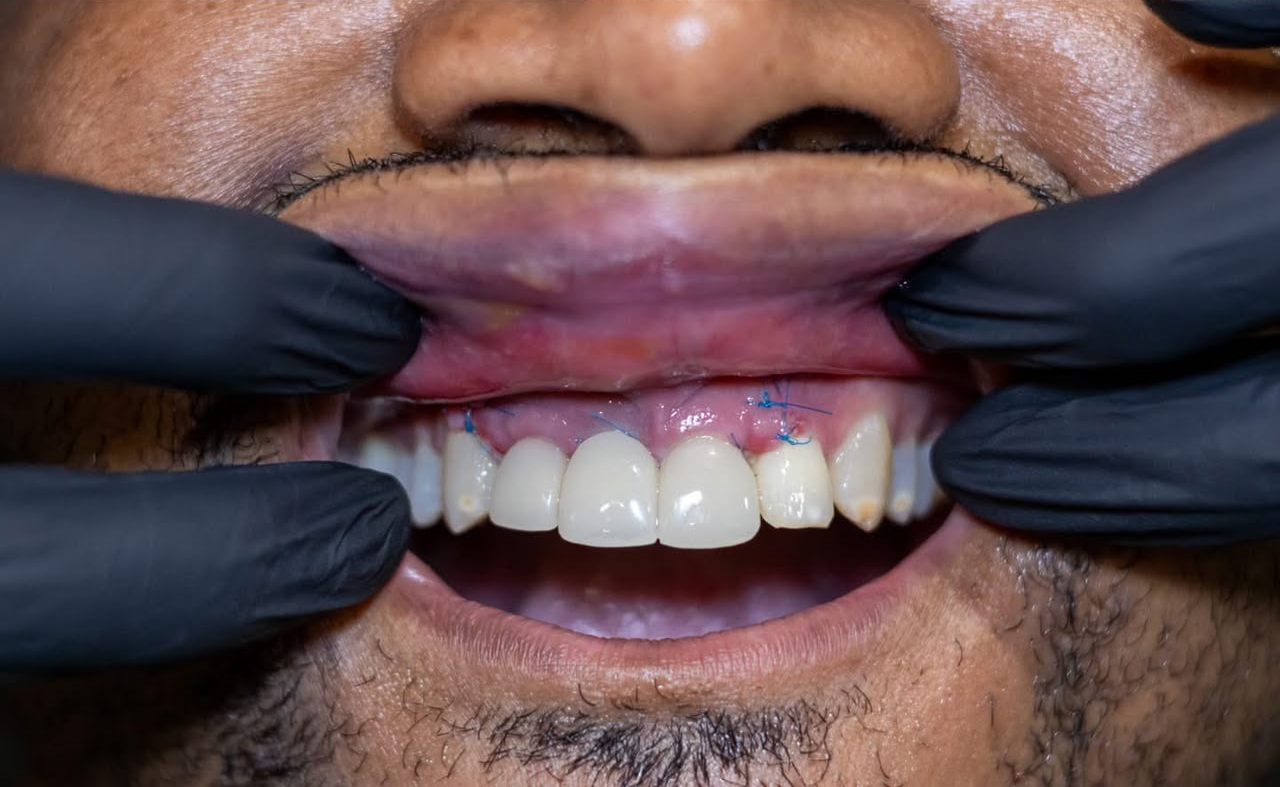 Crowns and bridges after treatment