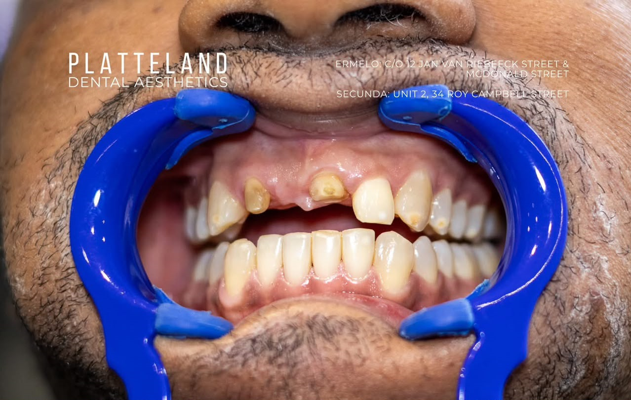Crowns and bridges before treatment