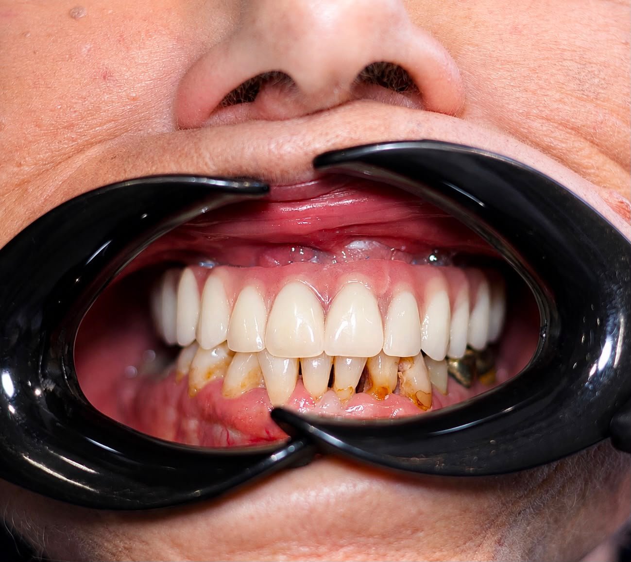 Dental implants after treatment