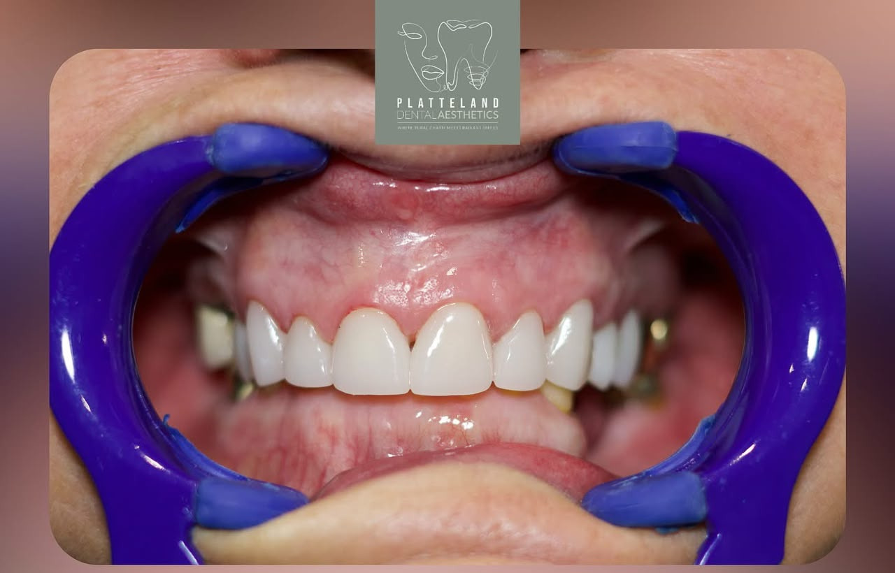 Full mouth rehabilitation after treatment