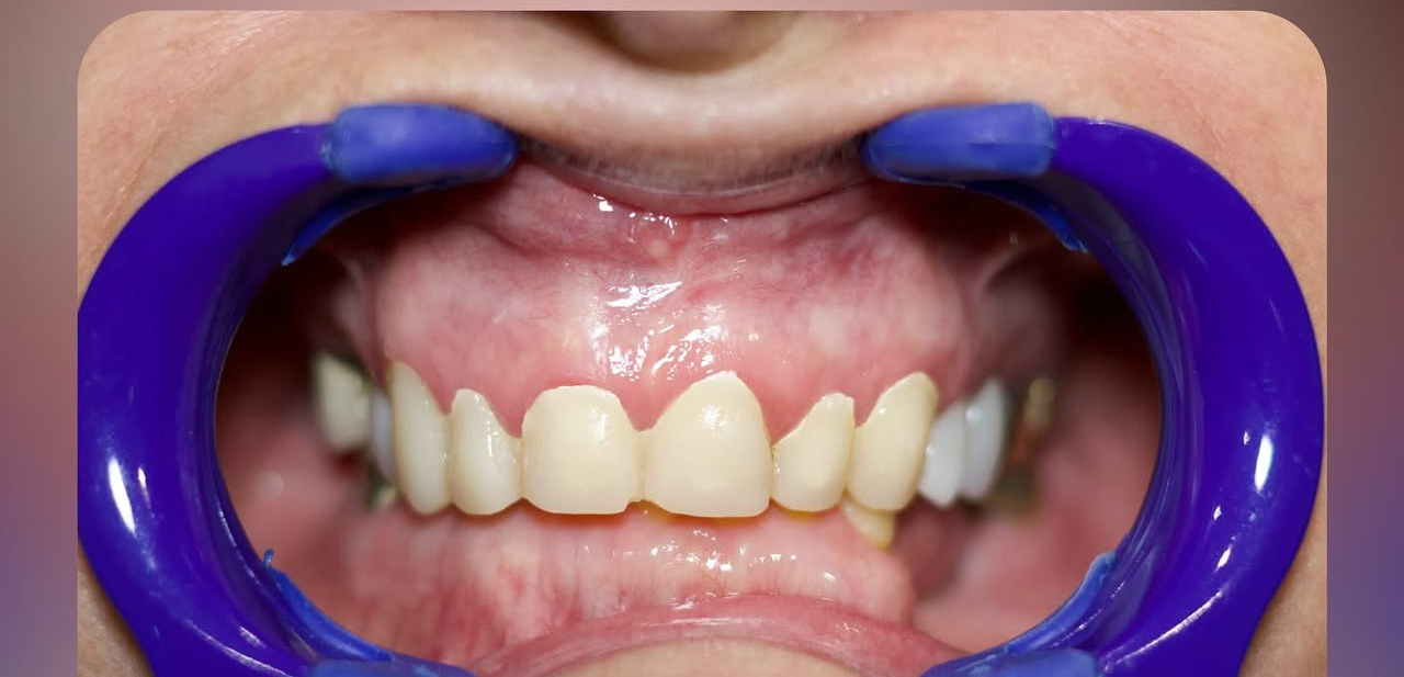Full mouth rehabilitation before treatment