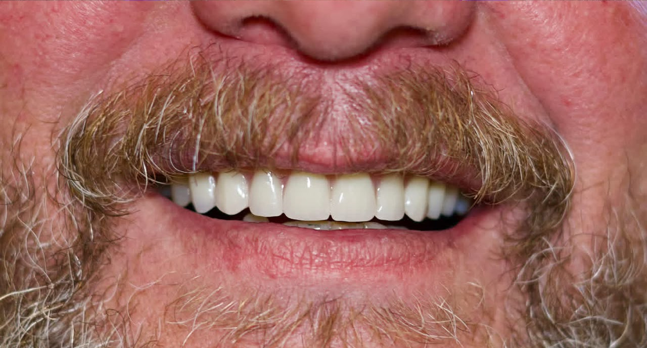 Smile makeover after treatment