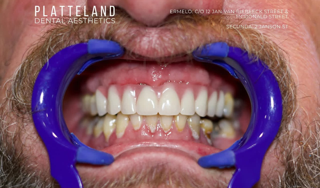 Smile makeover before treatment