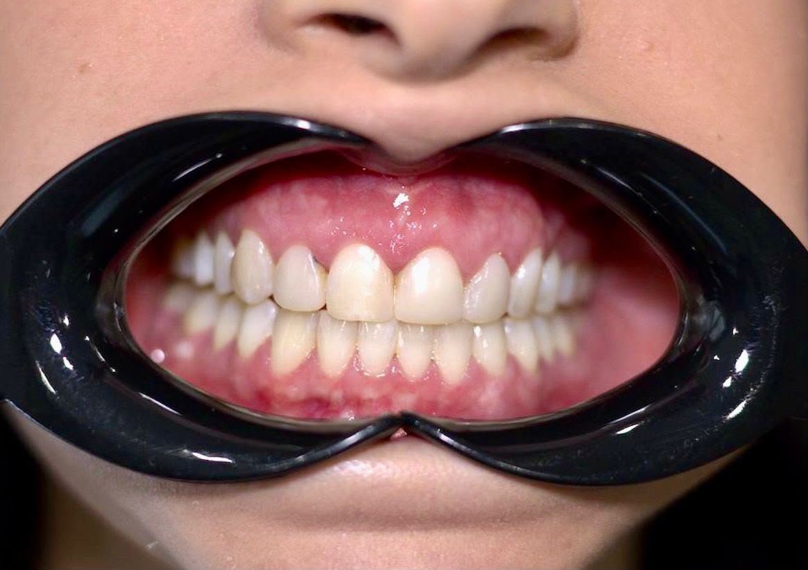 Veneers after treatment