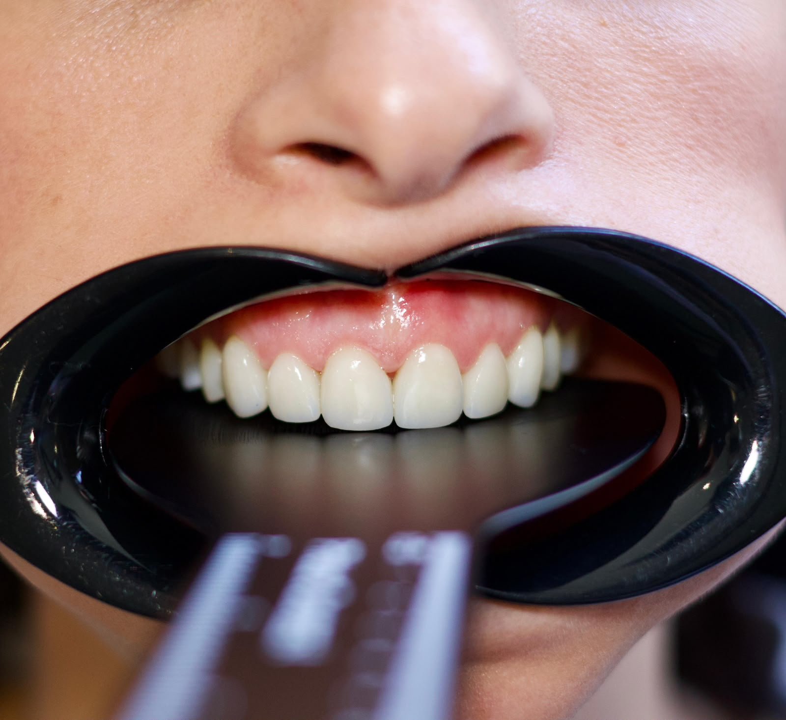 Veneers before treatment